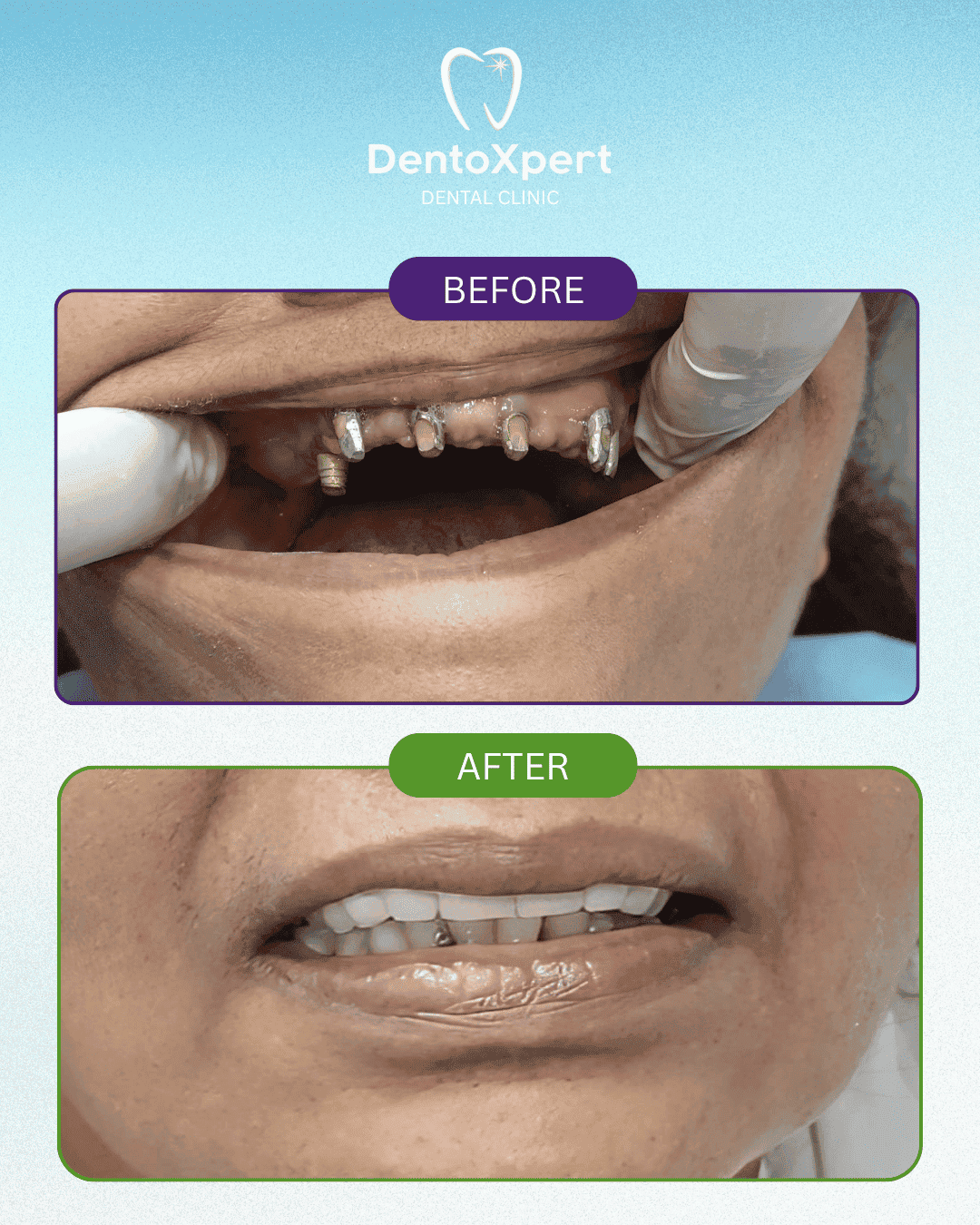 Before and after dental treatment result at DentoXpert Dental Clinic in Thane